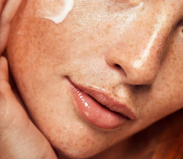 kako se riješiti hiperpigmentacija